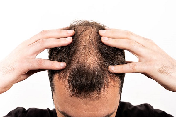 Saiba o que causa a queda de cabelo e como tratar!